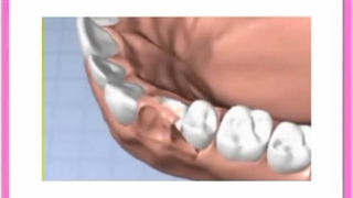 کاشت دندان ها بدون ایمپلنت