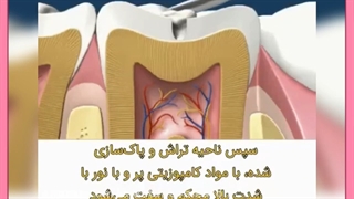 قیمت و هزینه پر کردن دندان چقدر است؟