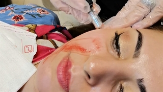 انجام میکرونیدلینگ برای جای جوش و جوش صورت با تاثیر فوق العاده ماموپلاستی