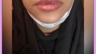 مدت ماندگاری ژل لب مدل عروسکی چقدر است؟