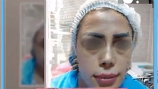 تزریق چربی به صورت بصورت تضمینی