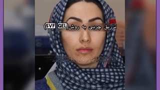 مهمترین قدم برای تزریق چربی به صورت چیست؟