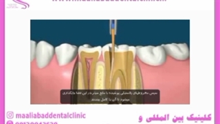 آیا درد دندان پس از درمان ریشه نگران کننده است؟