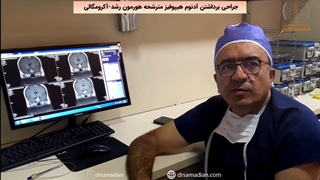 عمل جراحی برداشتن آدنوم هیپوفیز مترشحه هورمون رشد-آکرومگالی