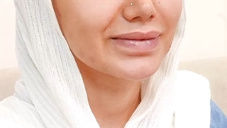 کاشت ابرو
