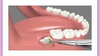 جراحی دندان عقل؛ مراقبت ها و توصیه ها