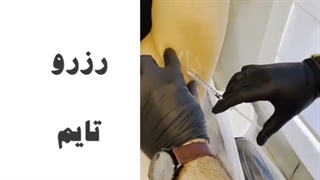 تزریق بوتاکس زیر بقل