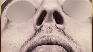 جراحی زیبایی بینی با قوز شدید