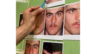 جراحی بینی با انحراف شدید - دکتر کیان احمدی