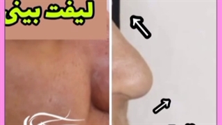 توصیه های قبل از لیفت بینی