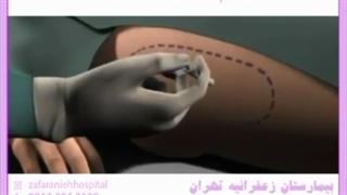 علل تعریق ران پا در زن ها چیست؟