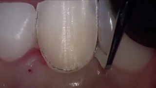 ترمیم پوسیدگی دندان