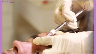 تزریق ژل به پیشانی لیزر موهای زائد