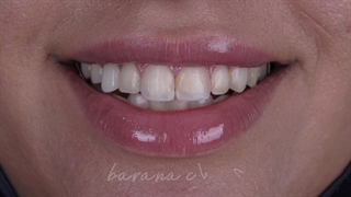 قبل و بعد طراحی لبخند با ونیرهای کامپوزیت در کلینیک بارانا