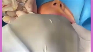 جراحی بوکال فت مناسب چه افرادی است؟