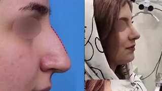 جراحی زیبایی اولیه بینی با افتادگی شدید نوک بینی