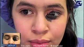 مرحله دوم جراحی خال بوسنده kissing nevus پلک پایین