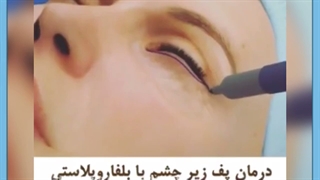 آیا برای برداشتن پف زیر چشم محدودیت سنی وجود دارد؟