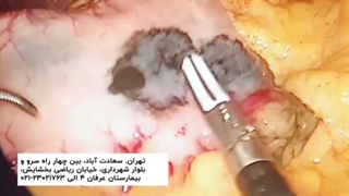 جراحی لاپاراسکوپی معده