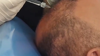 تزریق هیر فیلر- کلینیک زیبایی آنا