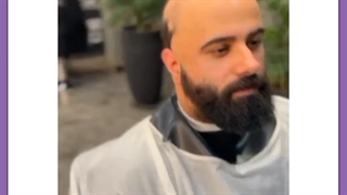 پروتز مو در مشهد توسط دکتر علیزاده