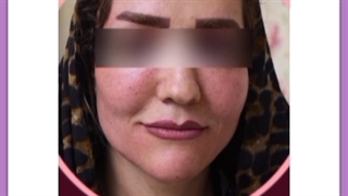 تزریق چربی با قیمت مناسب در اصفهان