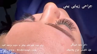 عمل جراحی بینی گوشتی با جدیدترین متد روز دنیا