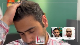 حس جوانی با کاشت مو فوق تراکم در بهترین کلینیک پوست و مو تهران