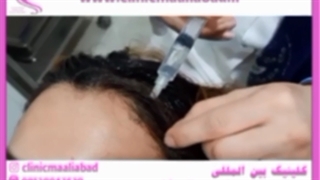 مقایسه مزوتراپی و کاشت مو و پی آر پی