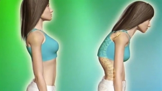 روش های درمان قوز کمر