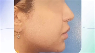 تأثیر جراحی بوکال فت در چهره
