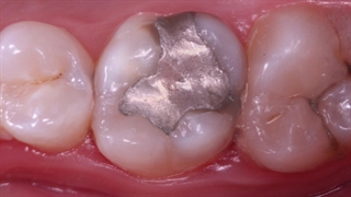 آمالگام یا کامپوزیت! برای پر کردن دندان کدام بهتر است؟ | سیمادنت