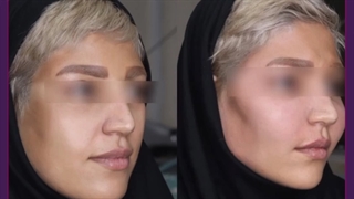 در چه نواحی می شود چربی تزریق کرد ؟