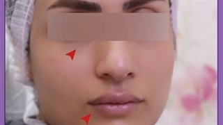 از چه سنی میشود تزریق چربی انجام داد؟