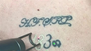 فیلم پاک کردن تتو (کلینیک زیبایی استاربیوتی)