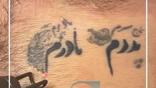 لیزر تتو (کلینیک زیبایی استاربیوتی )