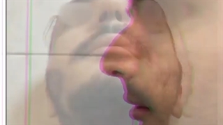 رینوپلاستی بینی