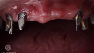 دکتر وحید دهقان : ایمپلنت فول فک بالا