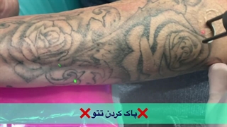 فیلم پاک کردن تتو (کلینیک زیبایی استار بیوتی )
