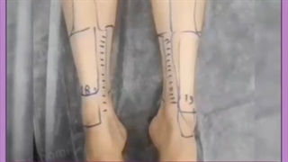 تزریق چربی ساق پا