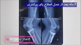 شش ماه پس از عمل پای پرانتزی