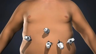 روش جراحی پلیسه معده (به انگلیسی gastric plication) چگونه انجام می‌شود؟