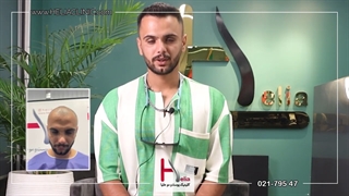 کاشت مو بعد از گذشت 8 ماه با تراکم عالی