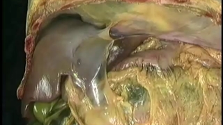 کبد و کیسه صفرا آکلند دوبله فارسی