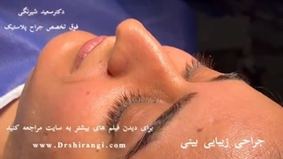 جراحی پلاستیک بینی - شکل بینی خود را اصلاح کنید