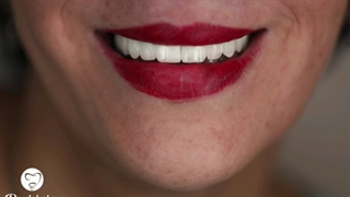 دکتر وحید دهقان : ایمپلنت فول فک بالا