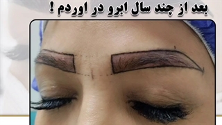 کاشت ابرو طبیعی