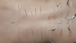 از بین بردن دردهای رماتیسم و سیاتیک از طریق طب سوزنی و جریان الکترود