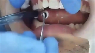 کامپوزیت زنیت - سبحان دنتال