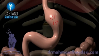 تشریح فرایند درمان نشتی معده با اندوسکوپی